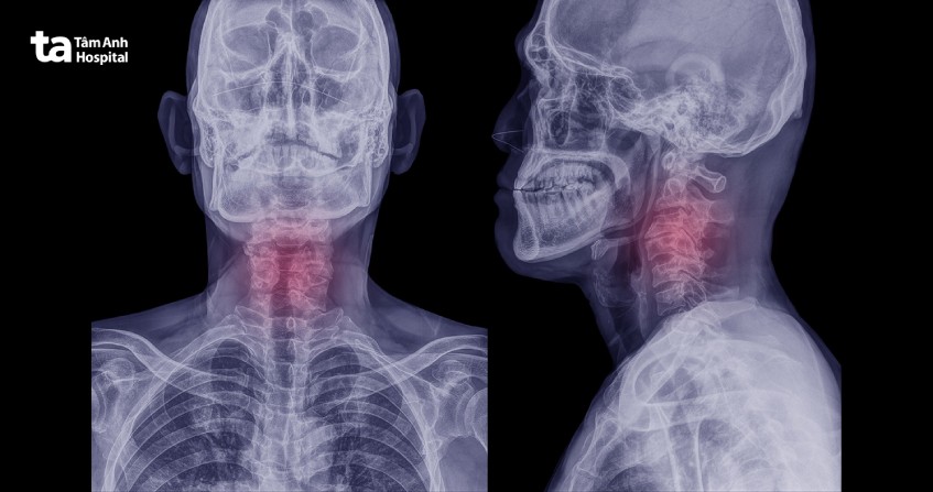 khi nào cần xquang cột sống cổ