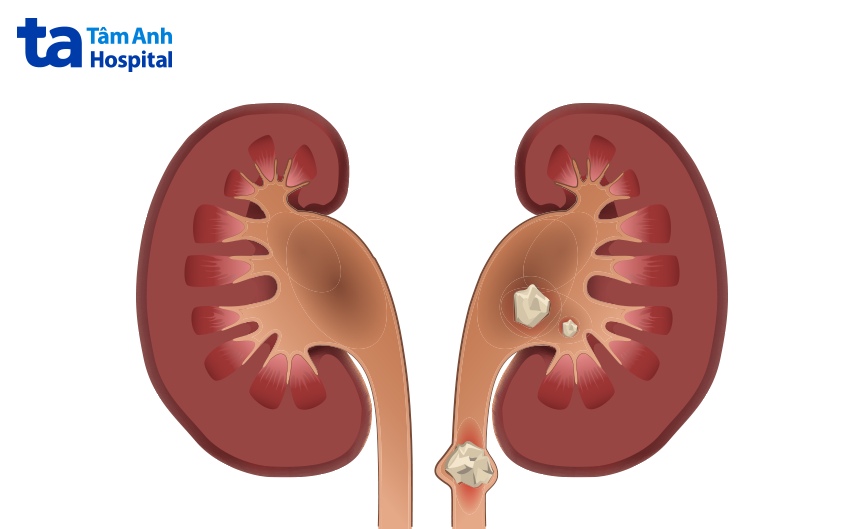 khi nào nên đặt stent niệu quản