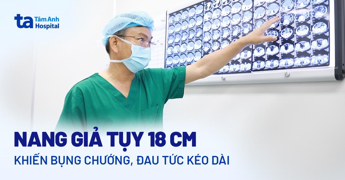 Nang giả tụy 18cm khiến bụng chướng đau tức kéo dài