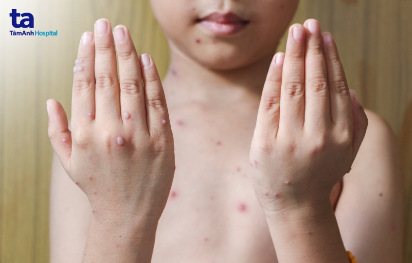 Nốt thủy đậu mọc khắp cơ thể của trẻ