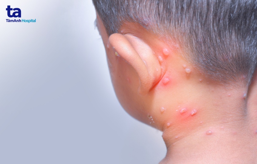 Nốt thủy đậu xuất hiện khắp cơ thể của trẻ