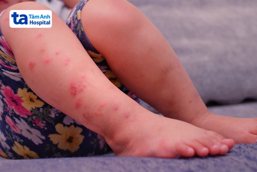 phát ban có thể xuất hiện ở chân, gối hoặc mông