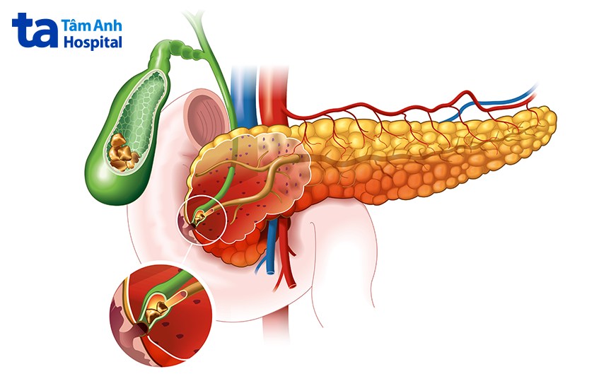 sỏi mật có tán được không 