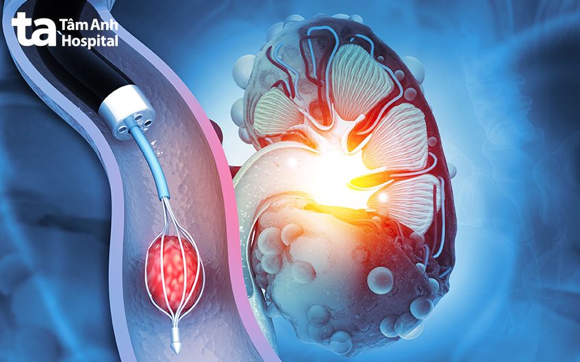 sỏi niệu quản có chữa được không