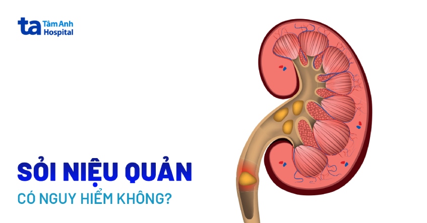 Sỏi niệu quản có nguy hiểm không? 12 biến chứng nguy hiểm