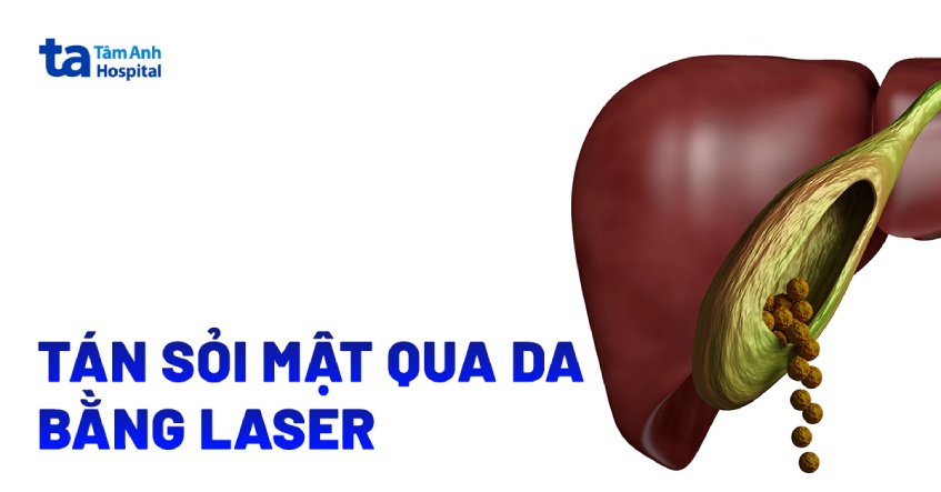 tán sỏi mật qua da