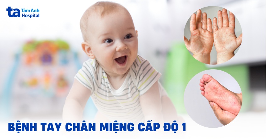 Bệnh tay chân miệng cấp độ 1: Triệu chứng và cách điều trị