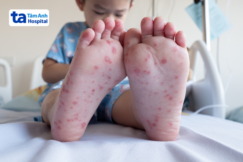 tay chân miệng cấp độ 2 với nhiều nốt phát ban đỏ ở lòng bàn chân