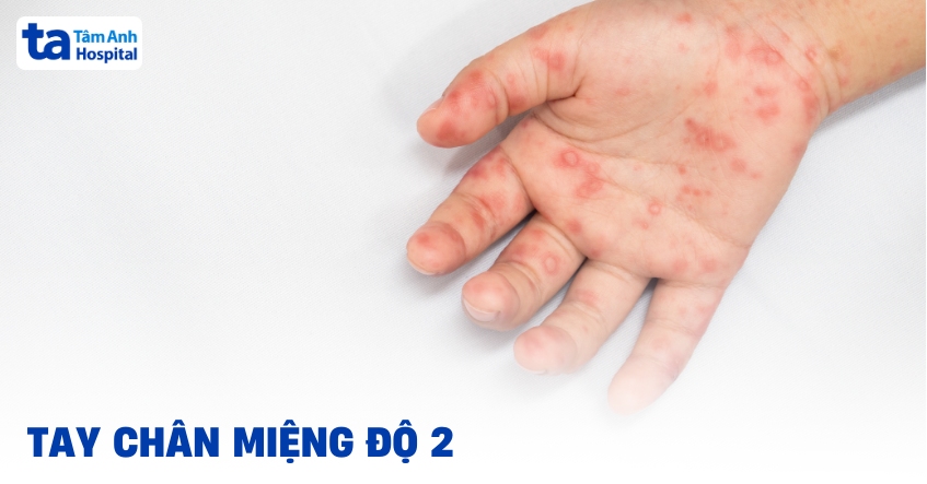 tay chân miệng độ 2