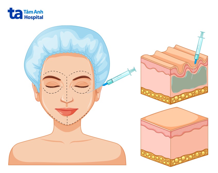 Tiêm filler giúp làm đầy cải thiện nếp nhăn trên da mặt.