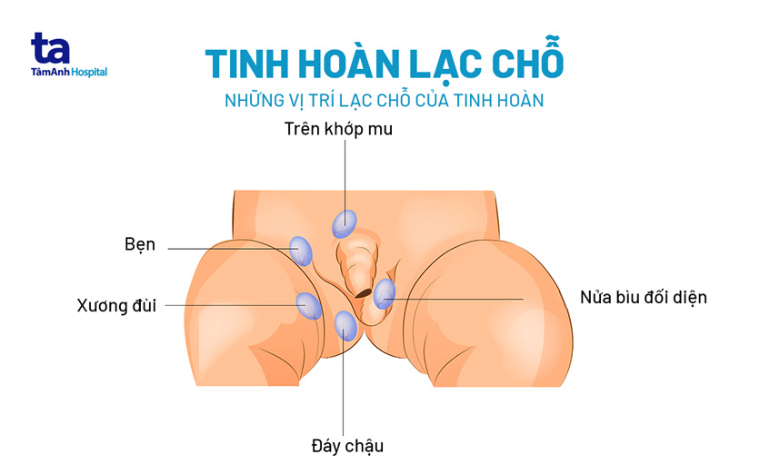 tinh hoàn không đúng vị trí