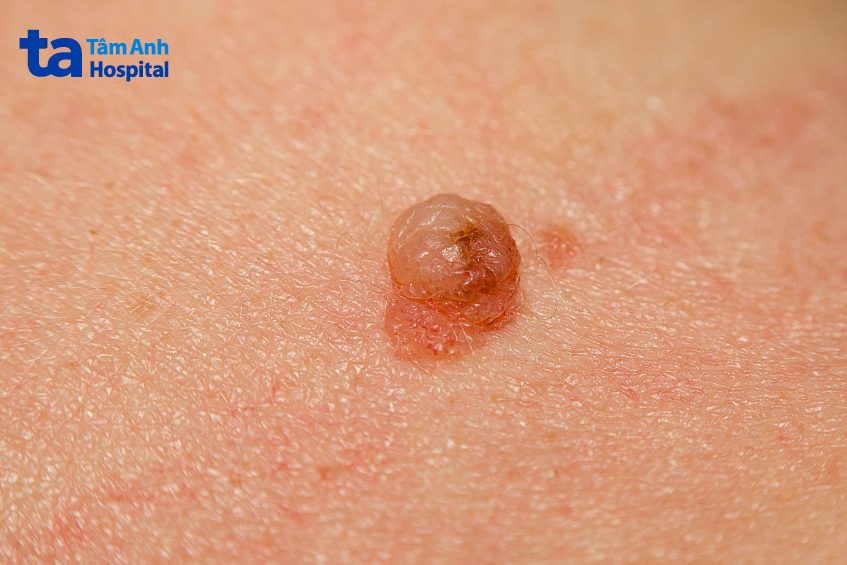 tổng quan về u nhú sinh dục