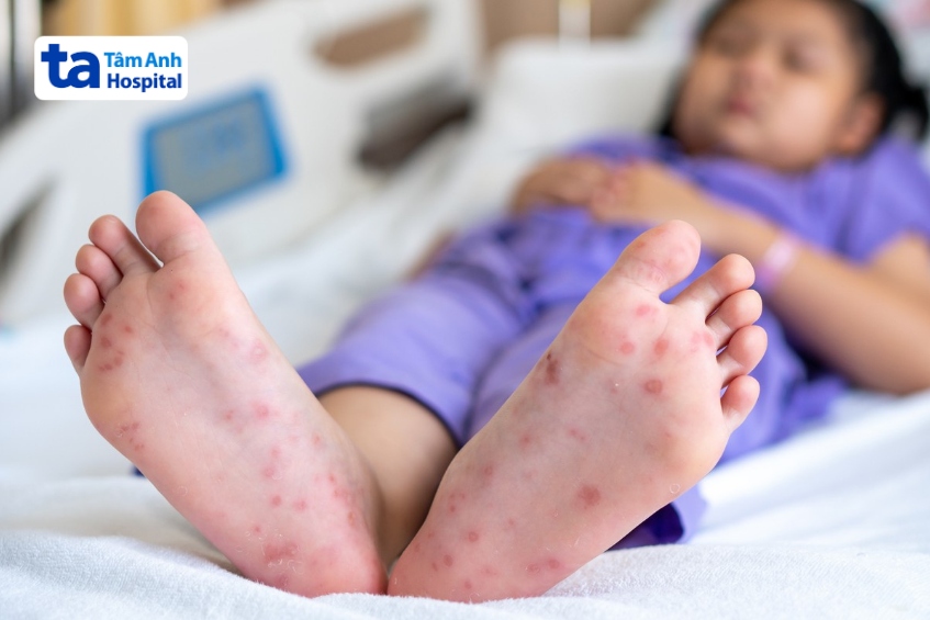 trẻ bị tay chân miệng độ 2 cần được nhập viện điều trị