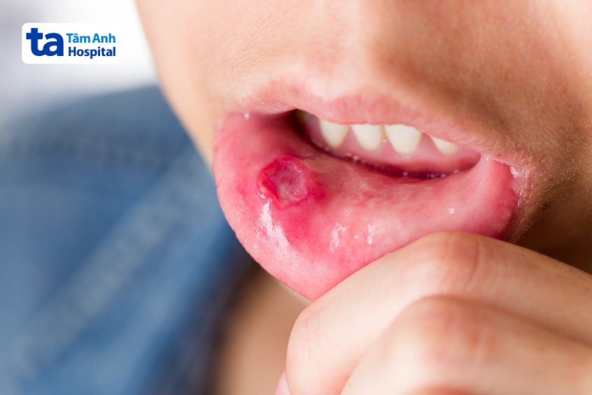 trẻ bị tay chân miệng độ 2 với vết loét miệng gây đau