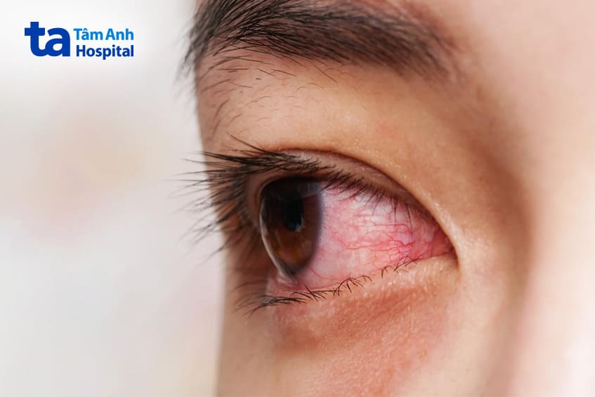 Triệu chứng viêm kết mạc mùa xuân