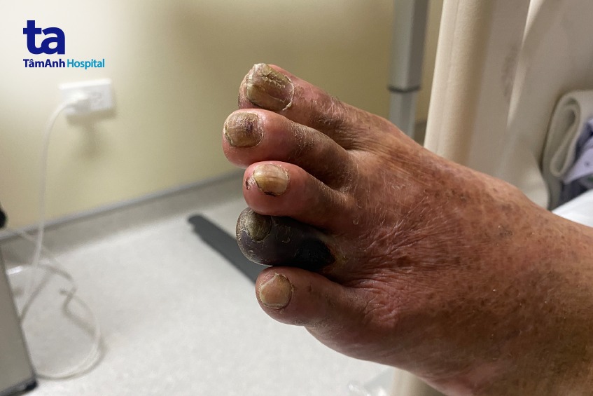 Tỷ lệ nhiễm trùng bàn chân tiểu đường