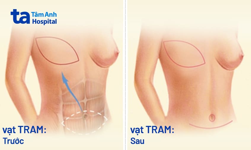 Tái tạo vú trì hoãn bằng vạt da cơ thẳng bụng (vạt TRAM) là gì?