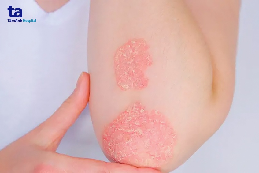 vảy nến tổn thương da