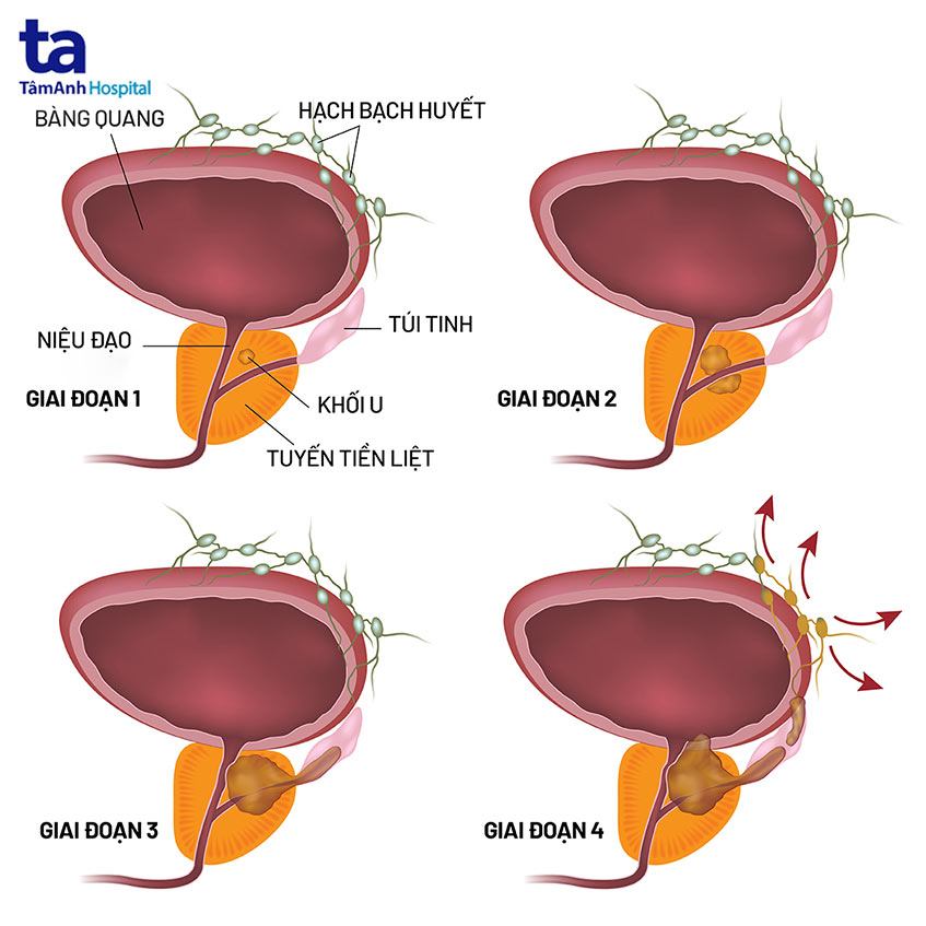 4 giai đoạn ung thư tuyến tiền liệt