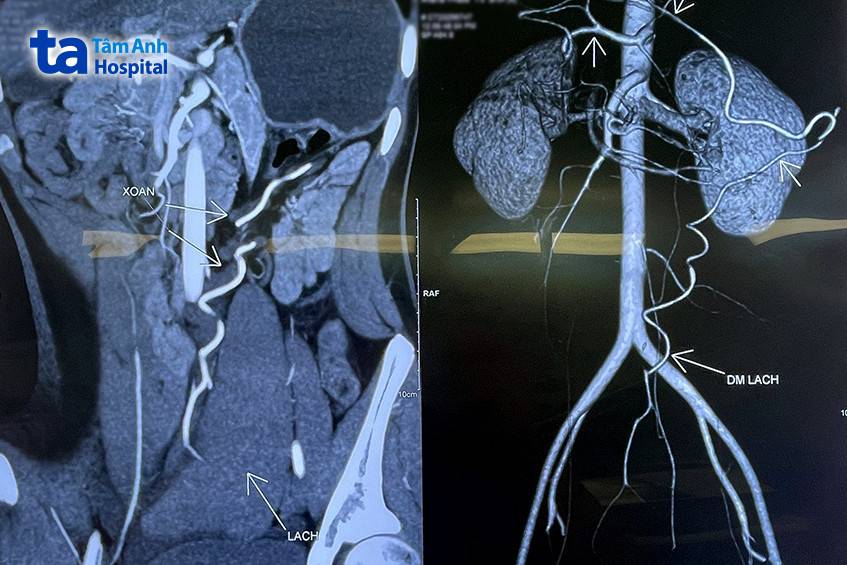 Hình ảnh xoắn lá lách