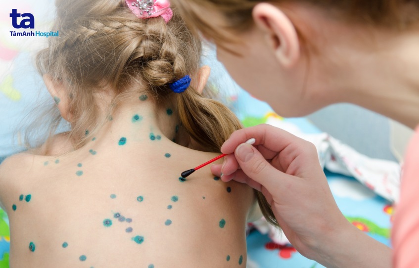 Bố mẹ chỉ nên chấm thuốc xanh Methylen