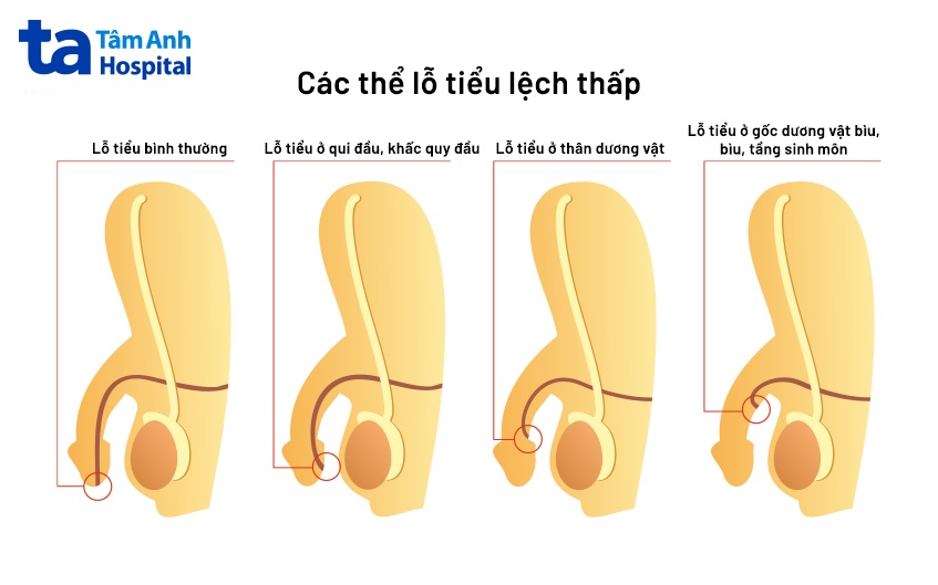 các thể lỗ tiểu lệch thấp
