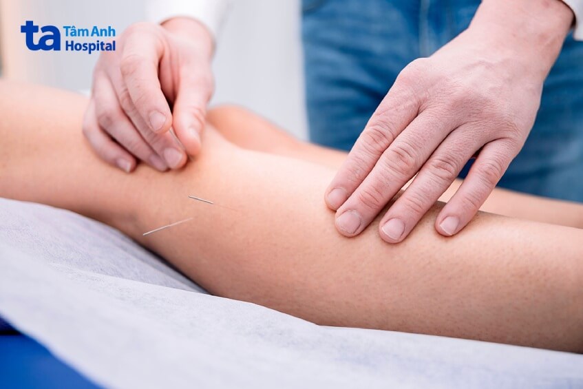 châm cứu điều trị bệnh viêm dây thần kinh