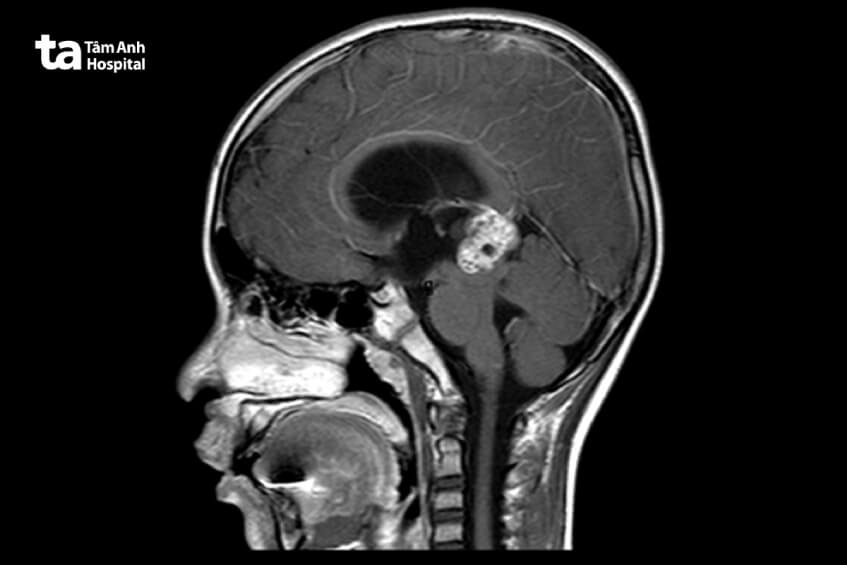 chẩn đoán hình ảnh phẫu thuật u tuyến tùng