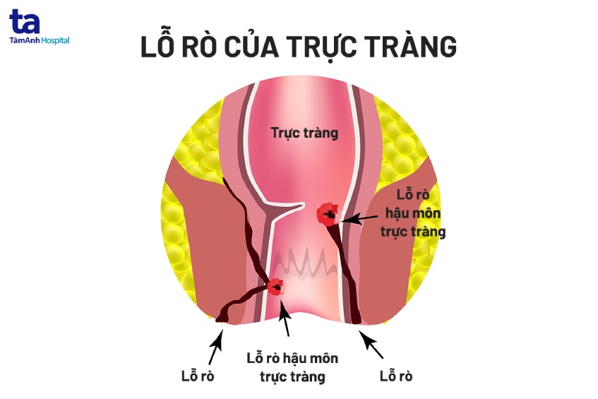 chẩn đoán rò hậu môn bằng chụp mri