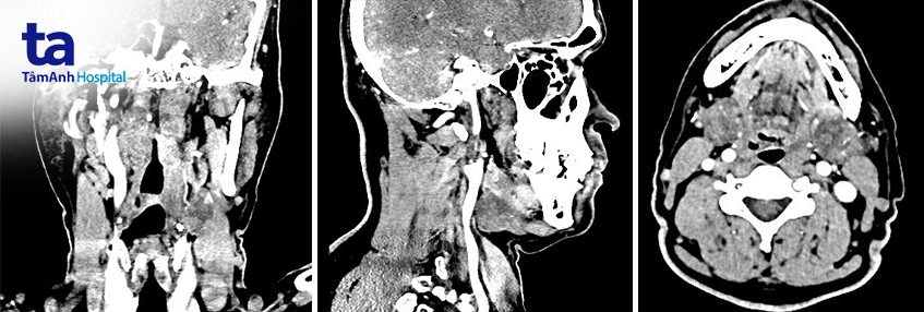 chẩn đoán u tuyến hàm dưới 