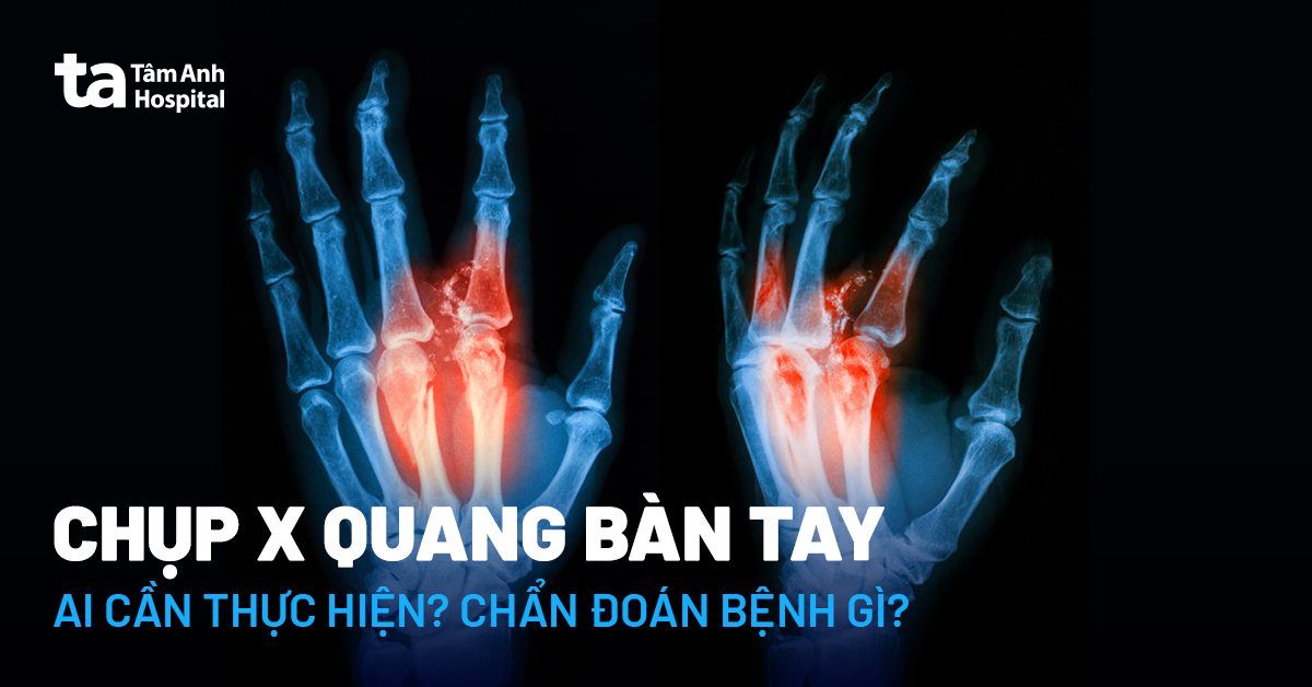Chụp X quang bàn tay: Khi nào cần và quy trình thực hiện ra sao?