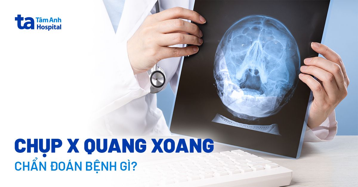 Chụp X quang xoang: Các tư thế chụp, quy trình và ưu nhược điểm
