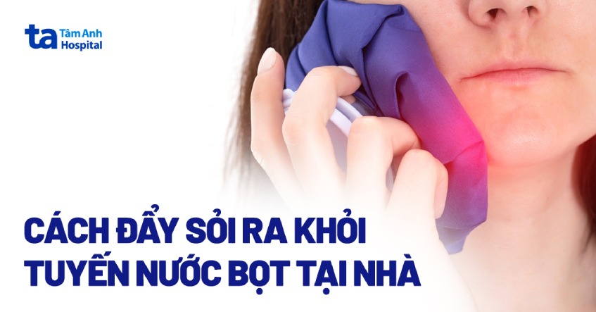 đẩy sỏi ra tuyến nước bọt