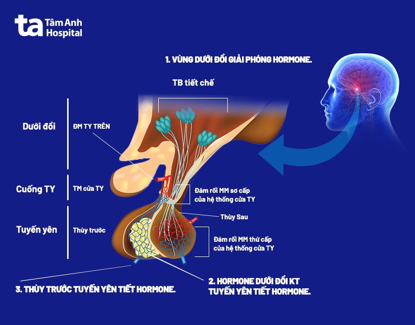 Đột quỵ tuyến yên xảy ra đột ngột