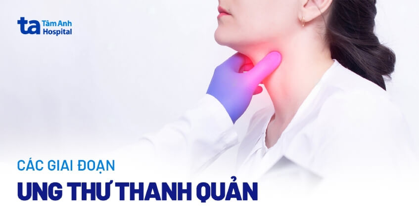 giai đoạn ung thư thanh quản