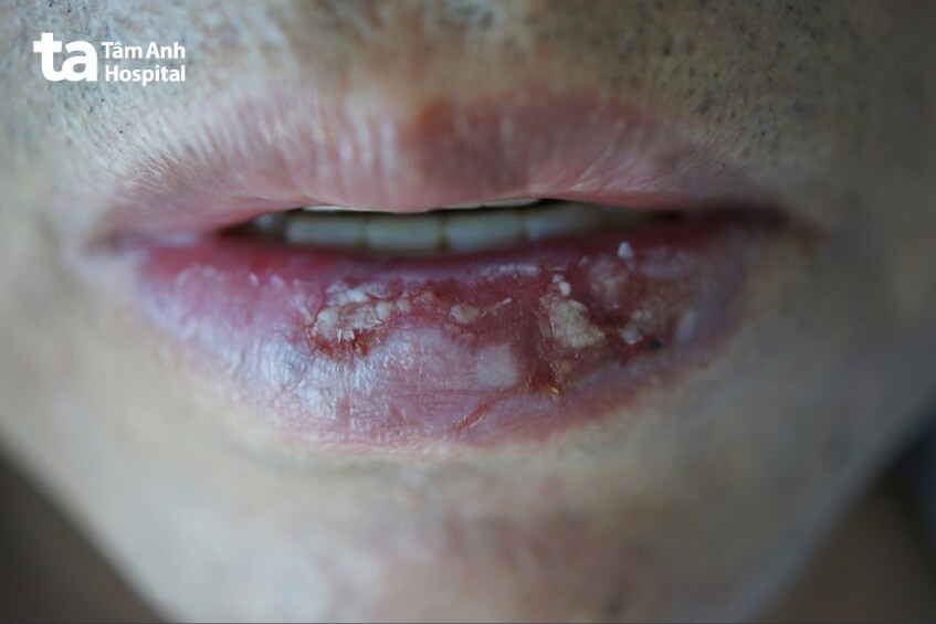 hình ảnh bệnh viêm môi ánh sáng