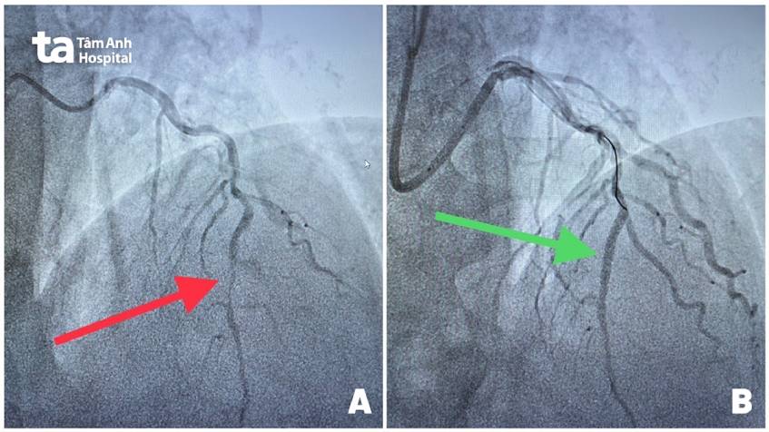Hình ảnh mạch vành phải tắc nghẽn (hình trái) và sau khi được đặt stent tái thông (hình phải). Ảnh: Bệnh viện Tâm Anh