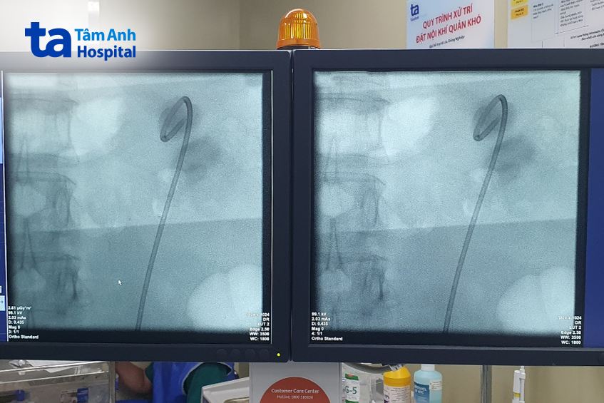 Hình ảnh trên C-arm 