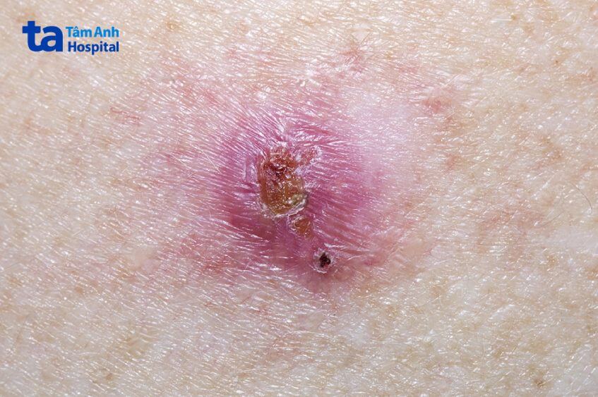 hình ảnh ung thư biểu mô tế bào đáy