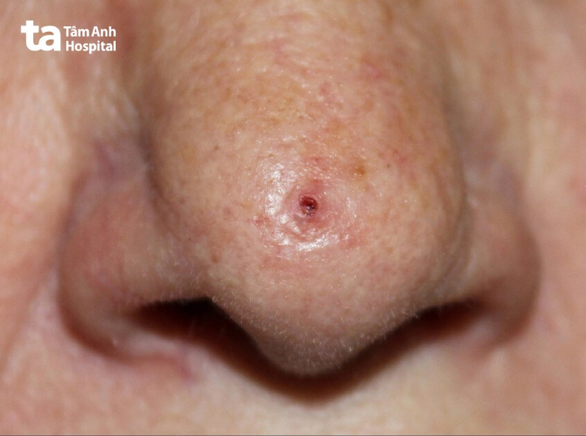 hình ảnh ung thư biểu mô tế bào đáy