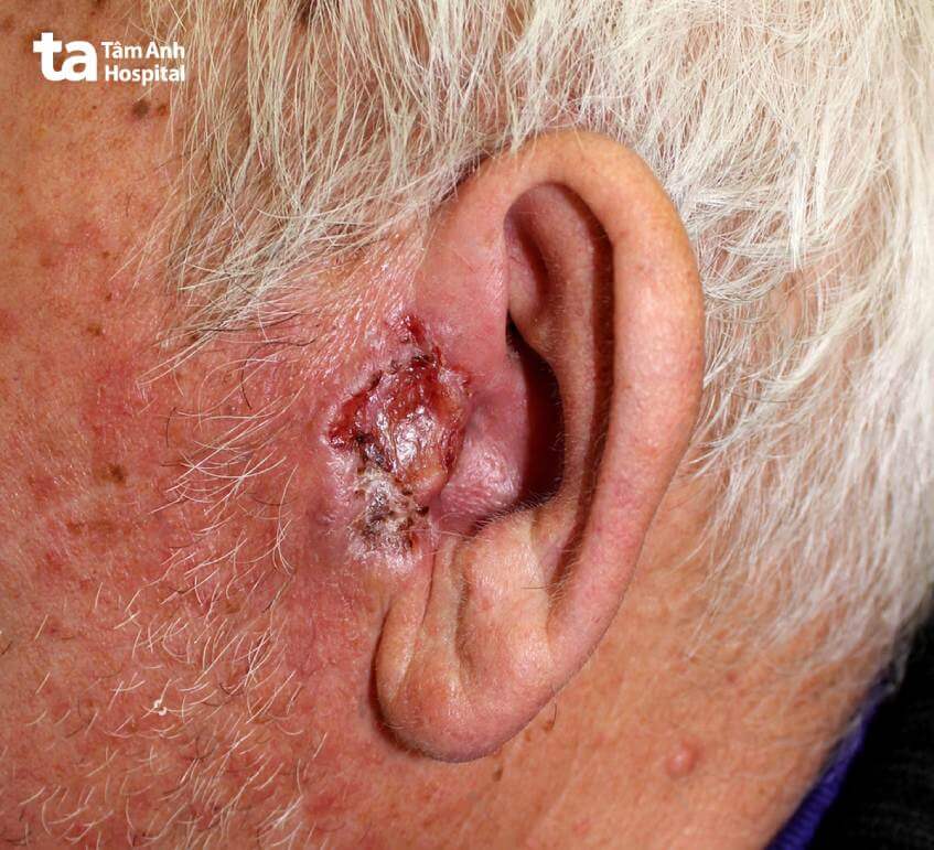 hình ảnh ung thư biểu mô tế bào đáy