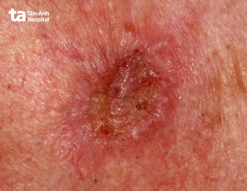 hình ảnh ung thư biểu mô tế bào váy