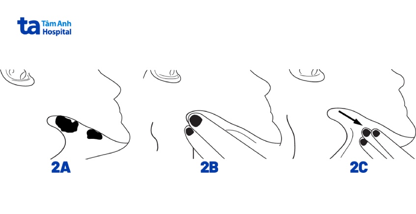 lấy sỏi tuyến nước bọt 2