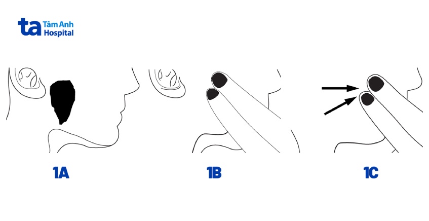 lấy sỏi tuyến nước bọt