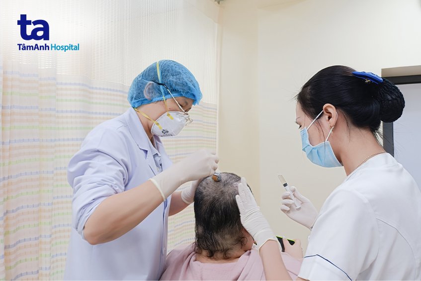 lưu ý khi điều trị hói đầu