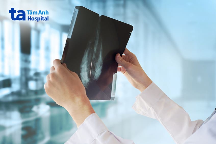 mức độ ung thư biểu mô tiểu thùy xâm lấn