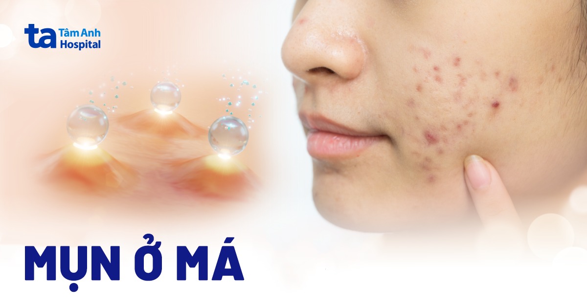 What is the recommended dosage of isotretinoin for treating hormonal acne?
