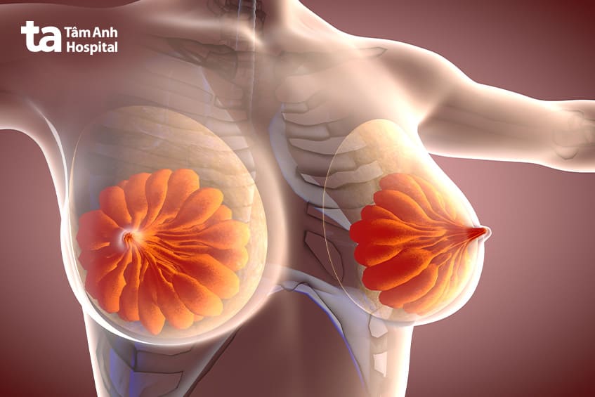 Người mang đột biến gen BRCA1 hoặc BRCA2 thì bị ung thư vú