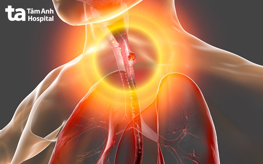 nguyên nhân nuốt nghẹn