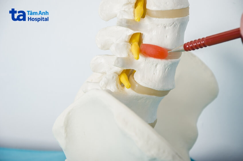 nguyên nhân viêm dây thần kinh